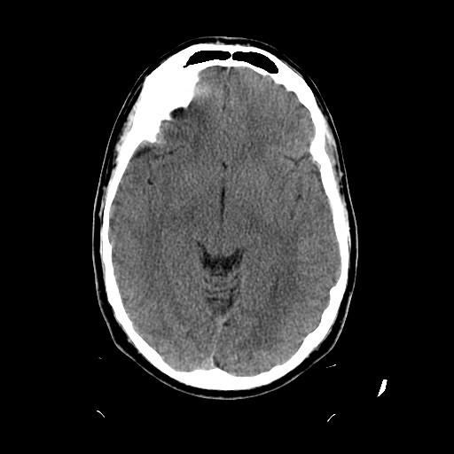 Our Patient: Non-Contrast Head CT Final read: negative for acute