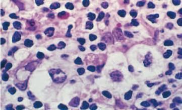 Hodgkin Cell Lacunar cells