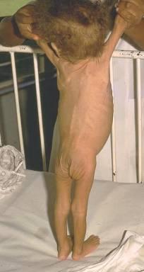 Acute Malnutrition: Marasmus Loss of subcutaneous fat and muscle In 1 st year of life associated with