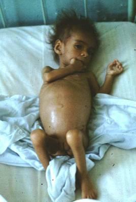 Kwashiorkor Associated with severe immune deficiency and early death
