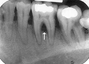 In health, the furcation area cannot be probed because it is filled with alveolar bone and periodontal ligament fibers. 3.
