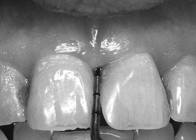 Supragingival or subgingival calculus and/or defective margins are detected.