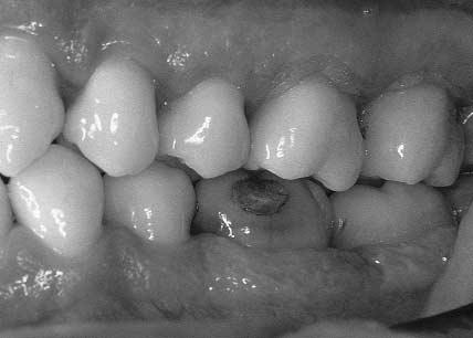 Light subgingival plaque on all surfaces with moderate subgingival plaque on the proximal surfaces on all teeth. b.