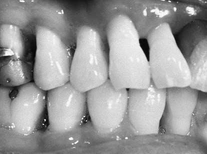 ADVANCED PROBING TECHNIQUES 445 Gingival margin Crest of bone Loss of Bone and Gingival Recession in Periodontitis.