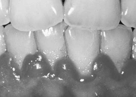 This is the natural position of the gingival margin. 2. Gingival margin significantly covers the CEJ. a. In this instance, the gingiva covers a significant portion of the tooth crown. b.