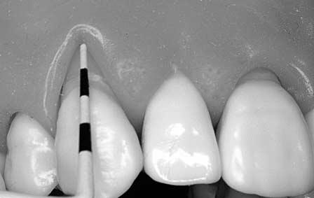 TECHNIQUE TO DETERMINE THE GINGIVAL MARGIN LEVEL When tissue swelling or recession is present, a periodontal probe is used to measure the distance that the gingival margin is apical or coronal to the