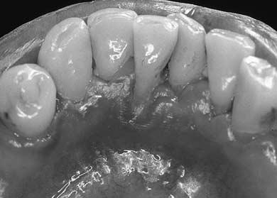 This distance is recorded as the gingival margin level. 2. When the gingival margin covers the CEJ.