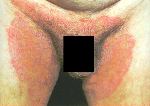 Ringworm of the groin (Tinea cruris or Jock itch) Groin and between legs Symmetrical,
