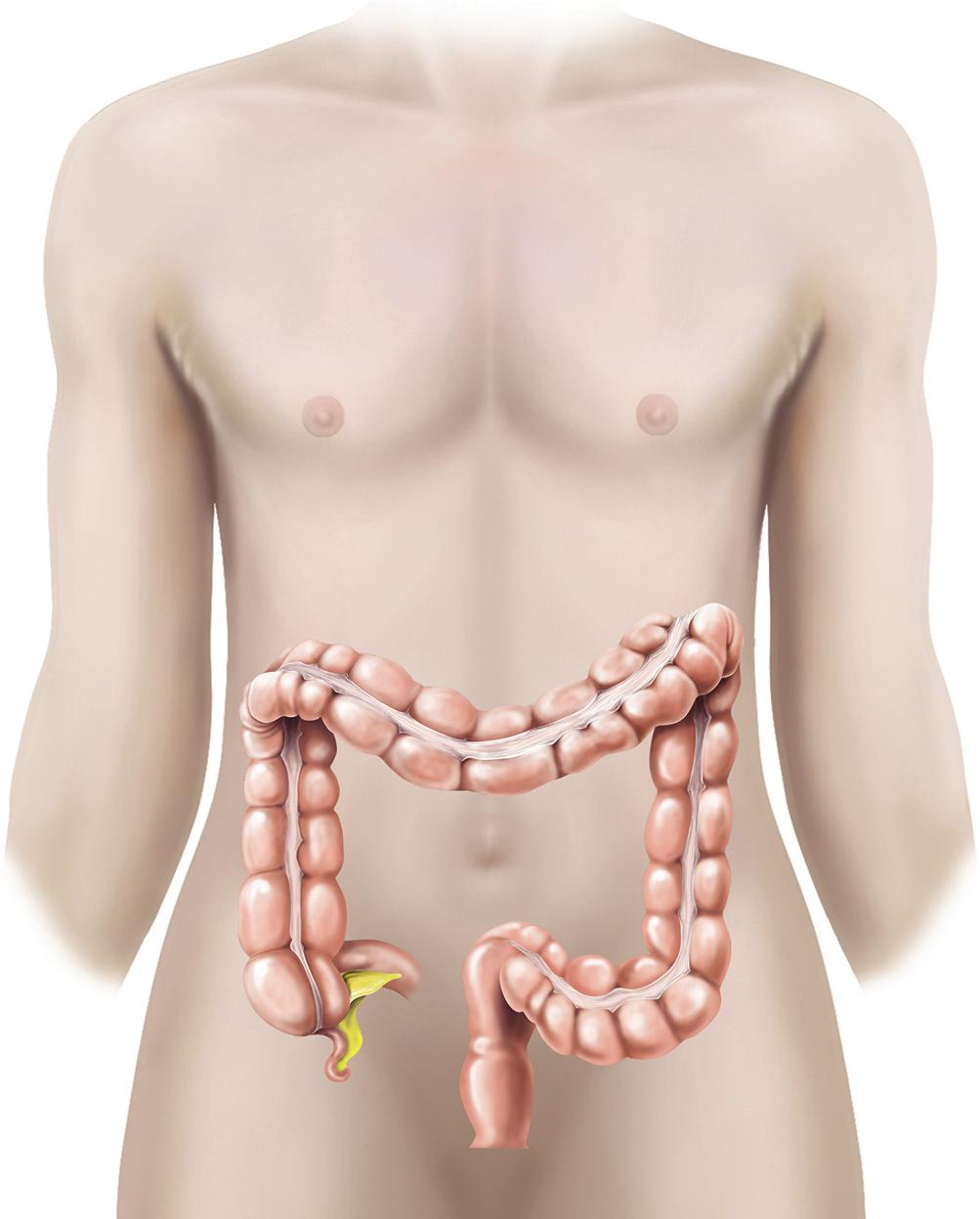 What is colon cancer? Colon cancer is a malignant growth that starts in the wall of your colon (large intestine). Colon cancer can cause your bowel habits to change.