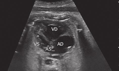 478 Claudiu Mărginean et al The role of ventricular disproportion, aortic, and ductal isthmus ultrasound measurements Table IV.