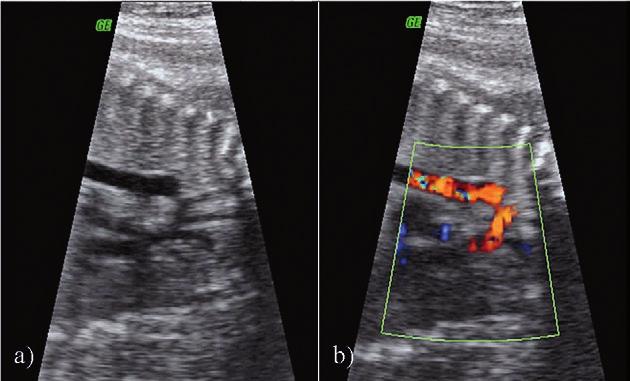 Fig 3. Fetal AoCo image in parasagittal view of the aortic arch and the descending aorta: a) gray scale: b) color Doppler. fulfilling these values. Five of these newborns (62.