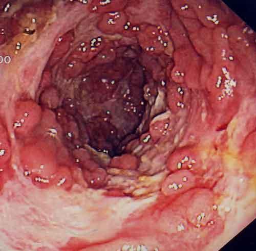 Slika 1: Endoskopska slika vnetja pri napredovani CB pseudopolipi, globoki ulkusi, tlakovan videz sluznice.
