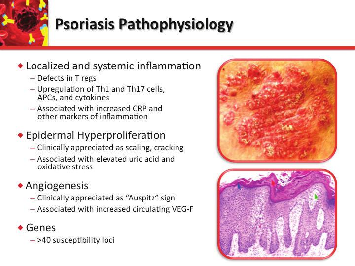 Psoriasis Pathophysiology u Localized and systemic inflammation Defects in T regs Upregulation of Th1 and Th17 cells, APCs, and cytokines Associated with increased CRP and other markers of