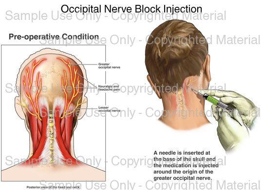 Greater occipital nerve block Combination of steroid and local anaesthetic 80mg Methylprednisolone and 20mg Lidocaine Useful as a bridging treatment or to give a period of respite Effect is