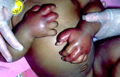 Sickle Cell Dactylitis