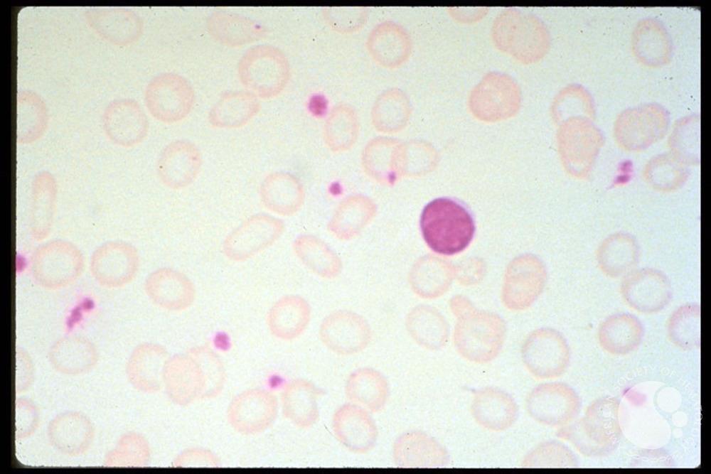 Iron Deficiency Anemia Severe Image ID: 60224 Authors: ASH Image Collection Category: Underproduction