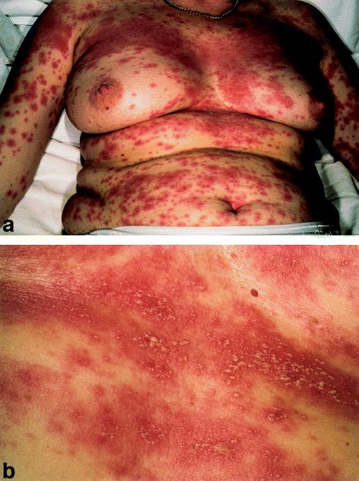 Terbinafine case 1: 69 year-old woman with intertriginous redness in skin folds Systemic terbinafine given for 4 weeks
