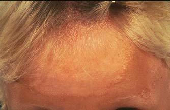 Case: Outbreak of tinea capitis During a 6 month period 5 children were referred to hospital with diagnoses