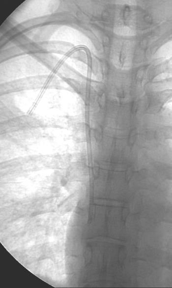 SVC/RA Junction Right Tracheobronchial Angle Right mainstem bronchus is upper margin of SVC Catheter tip within first 3 cm below right TBA Carina (usually within 1