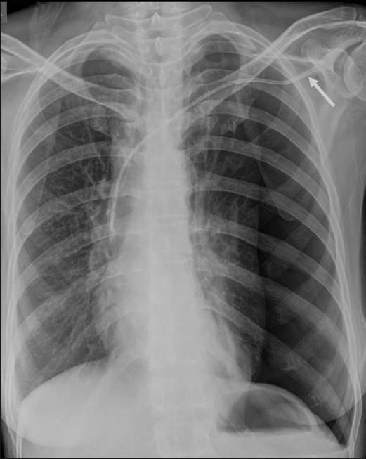 Pneumothorax Up to 10% surgical series 1-2% IR series (mainly subclavian) Operator