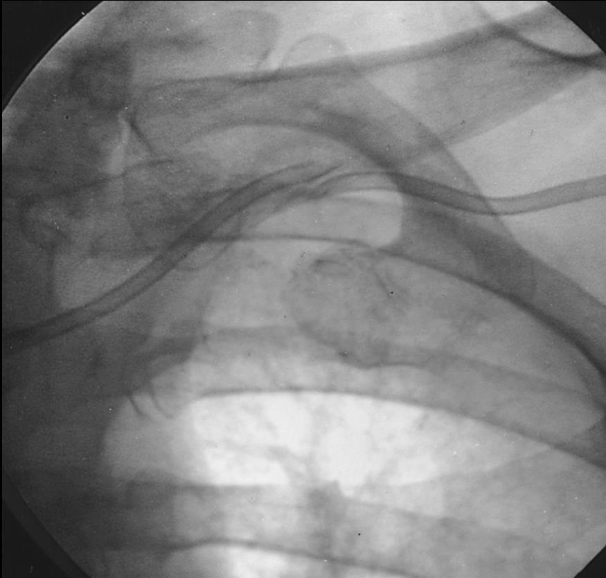 Catheter Pinch Off Mainly with subclavian ports Kinking of