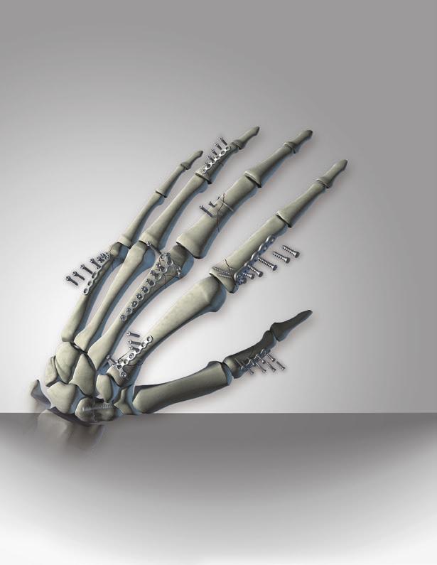 versatile SOLUTION for COMPLEX fractures hand plating system hps provides everything you need to treat the personality of the fracture.