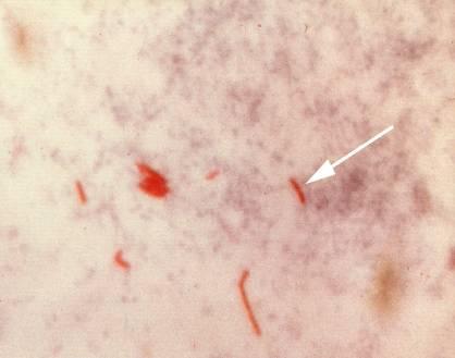 AFB smear make sure you get sputum smear results! AFB (shown in red) are tubercle bacilli AFB Smear Status Defined as the amount of M.