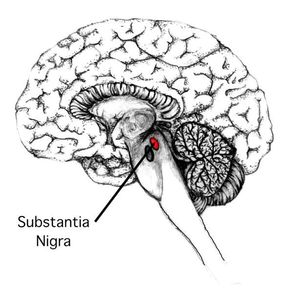 Results from progressive failure of dopamine-generating cells in the substantia nigra and associated