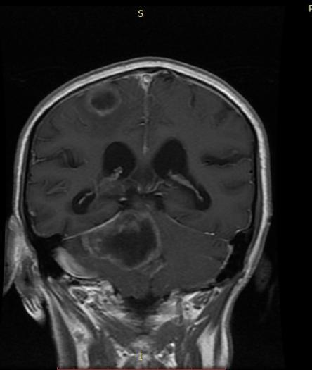 weighted images showing Multiple lesions