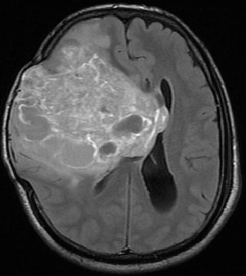 (c) (d) Figure 2: (a) and (b) Coronal T1W post contrast and axial T1W images showing hyperintense Suprasellar mass with enhancement on post contrast study in a patient with Craniopharyngioma.