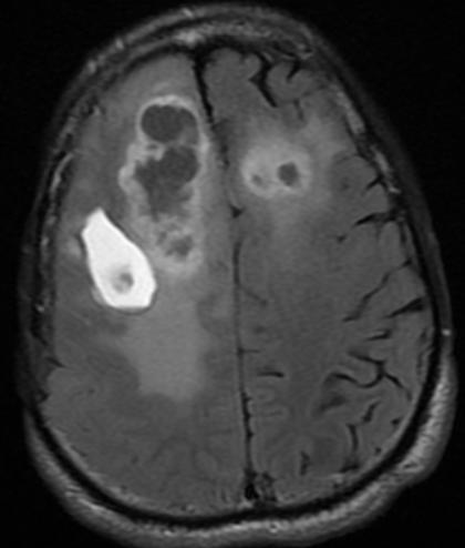 Discussion We studied 100 cases; out of which glioma was the most common tumour followed by meningioma.