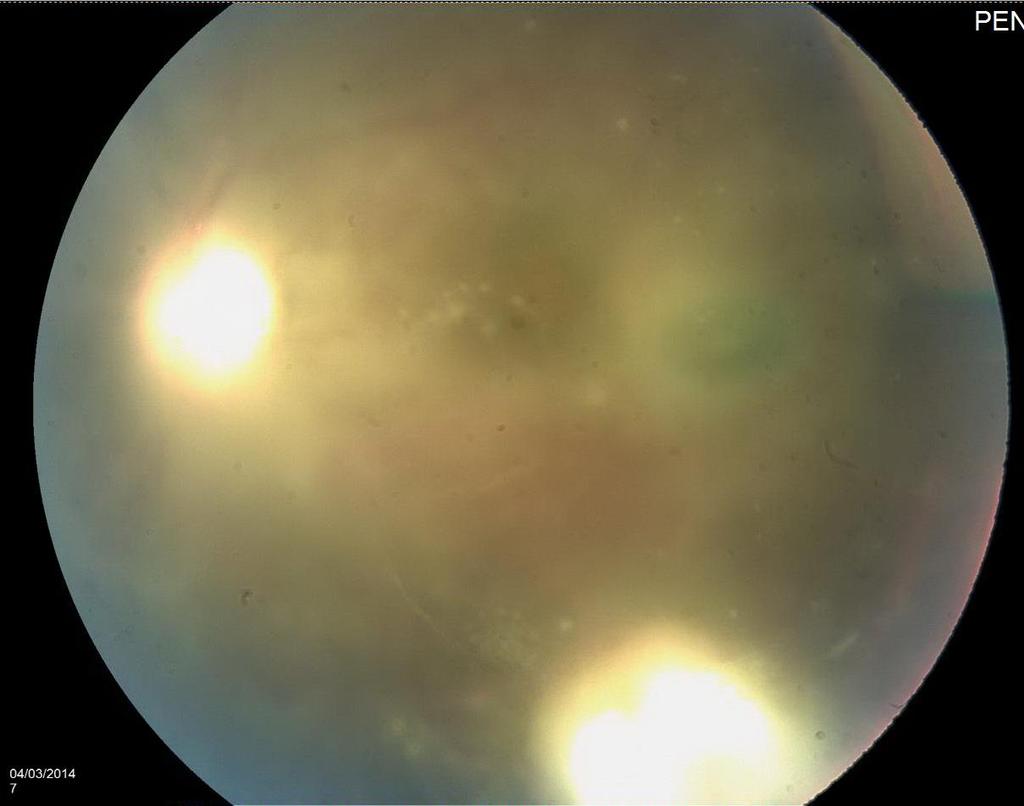 Left fundus: Vitreitis/ hazy view with significant