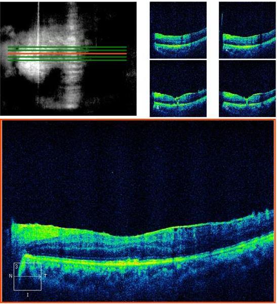 Optical coherence tomography: Abnormal left
