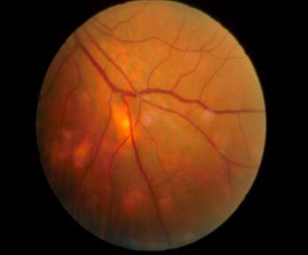 Tuberculosis: Ocular Findings Intraocular inflammation Posterior uveitis (most common presentation) Tuberculoma (immunocompromised host) Multifocal choroiditis ( miliary disease) Anterior uveitis
