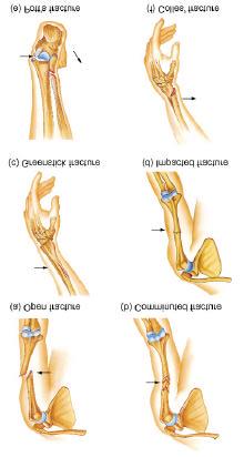 open fracture --skin broken comminuted -- broken ends of bones are fragmented greenstick -- partial fracture impacted -- one side of fracture driven into the interior of other side stress fracture --