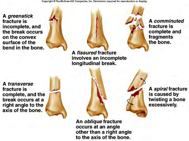 Page 12 Bone Disorders Types of Fractures 23 Bone Disorders Fractures and their Repair 24 The Healing of Fractures A bone fracture results in a hematoma from torn blood vessels.