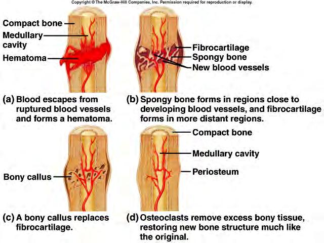 Page 13 Bone Disorders Fractures and their Repair 25 Bone Disorders Treatment of Fractures 26 Fractures may be set by: closed reduction no surgery open