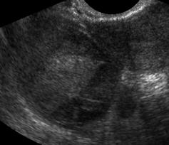 pelvic sonography has enhanced our ability to