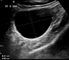 Observation is a reasonable option for smaller masses with benign sonographic characteristics Surgical management encouraged for larger, >7 cm benign appearing mass risk of torsion!