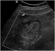 compression initial imaging test in pregnant females but often inconclusive