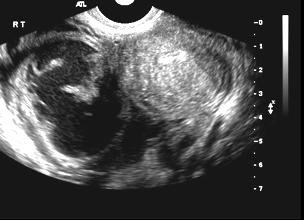 inflammatory disease ovarian torsion Functional ovarian cysts Pelvic inflammatory disease Ovarian torsion Acute abdominal