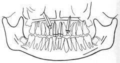 . 2. On the panoramic radiograph, the height of the tip of the crown of each displaced canine was assessed in the vertical plane relative to the ipsilateral central incisor.