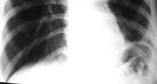 9% Presented to emergency department (ED) with complaints of cough for 2-3 weeks, some weight loss and fatigue CXR: RLL infiltrate Given Levofloxacin for 10 days and sent