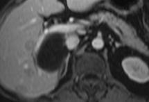 LIVER CYST