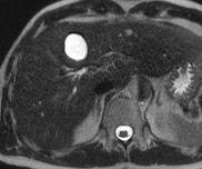 LIVER CYST