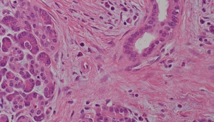 55) Extra-cellular fibrosis in both pancreatitis and adenocarcinoma