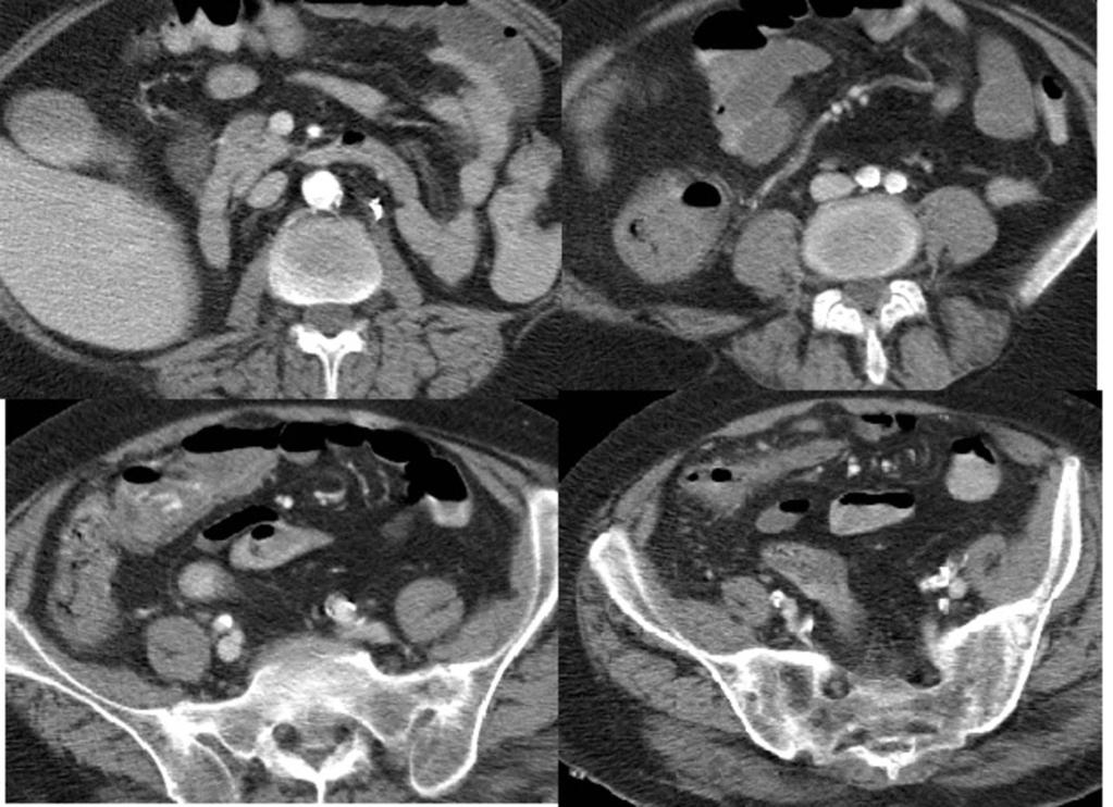 Axial unenhanced CT scan (left imaging) and axial CT