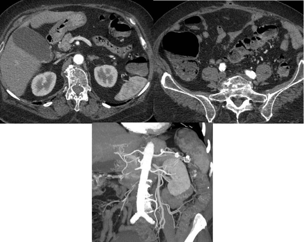 Fig. 3: Signs of ileum Angiodysplasia. CT angiogram shows early filling of ileocolic and superior mesenteric veins and hypertrophied of the antimesenteric ileum veins.