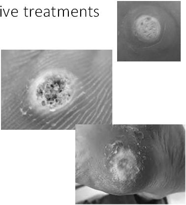 for standard warts (excluding face, genitals) 40% may be helpful for plantar warts or large, thick