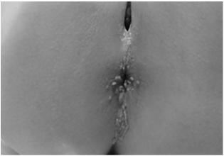 findings Anogenital warts in children Risk of sexual abuse is higher if > 3 years of age Non sexual transmission likely if: Child is < 3 years old at onset of warts Child also has